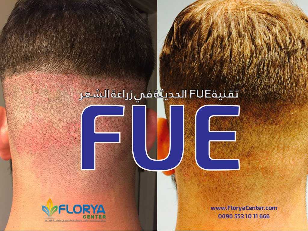 تقنية FUE الحديثة في زراعة الشعر