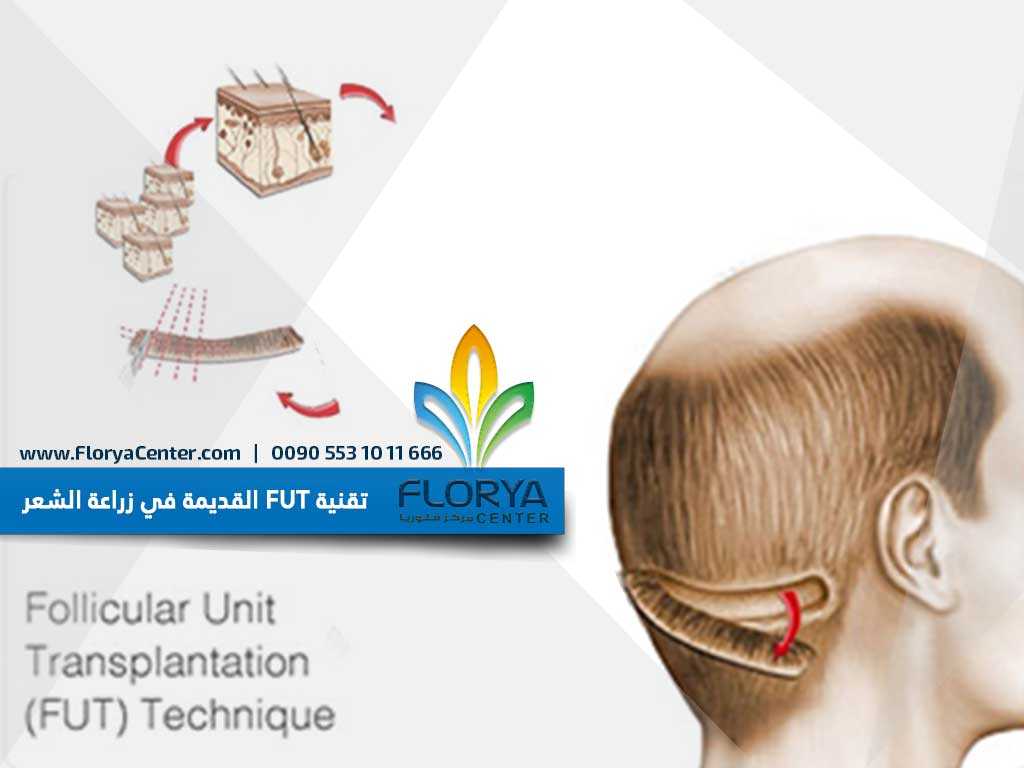 تقنية FUT القديمة في زراعة الشعر