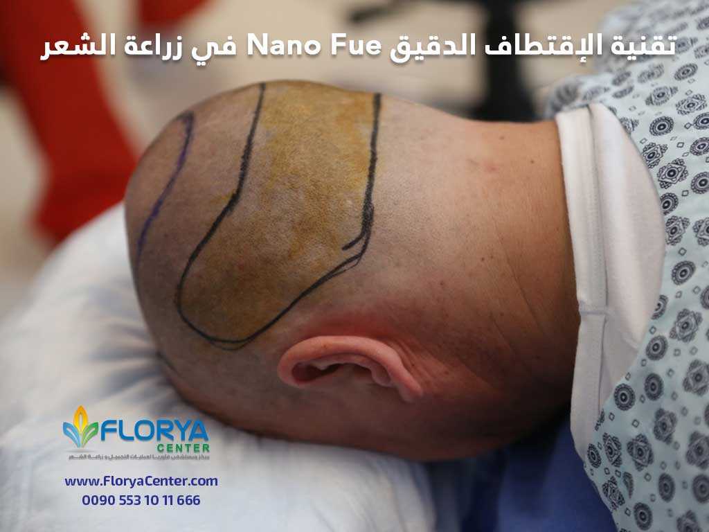 تقنية الإقتطاف الدقيق Nano Fue في زراعة الشعر