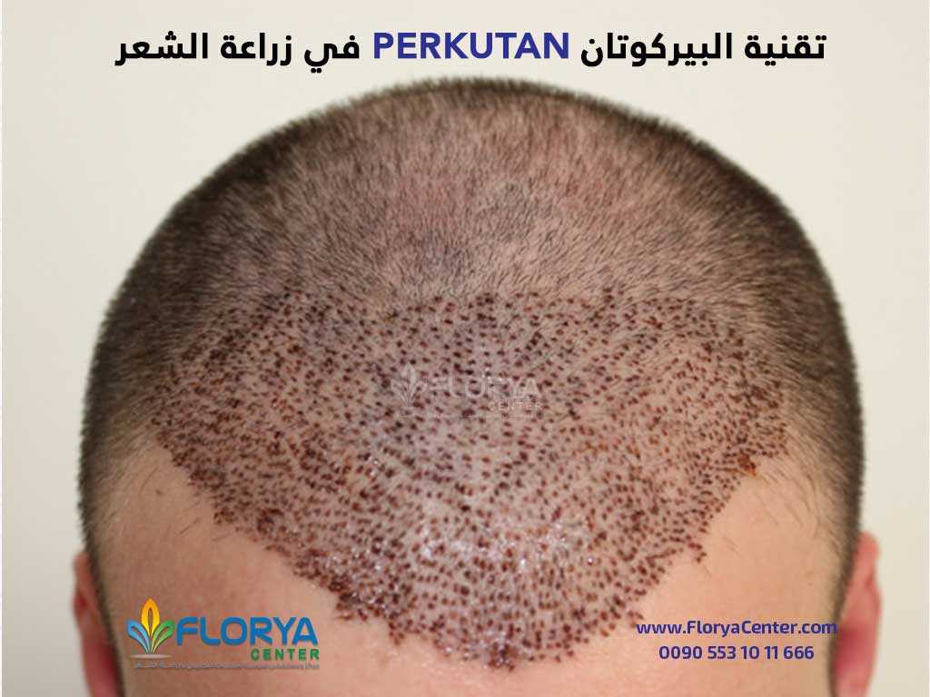 تقنية البيركوتان PERKUTAN في زراعة الشعر