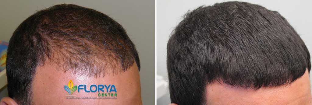 زراعة الشعر قبل و بعد