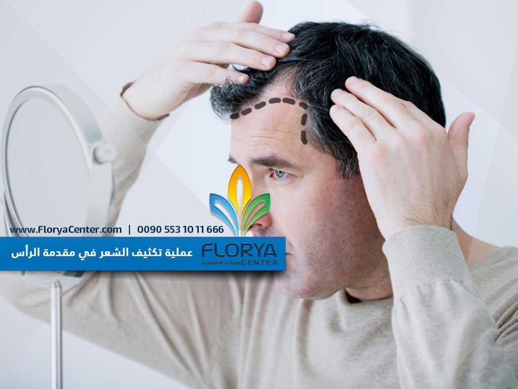 عملية تكثيف الشعر في مقدمة الرأس