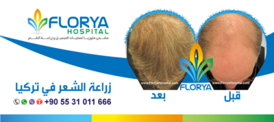 قبل و بعد عمليات زراعة الشعر في تركيا