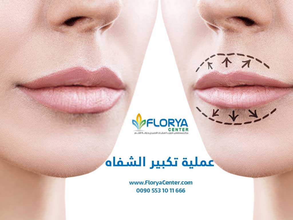 عملية تكبير الشفاه