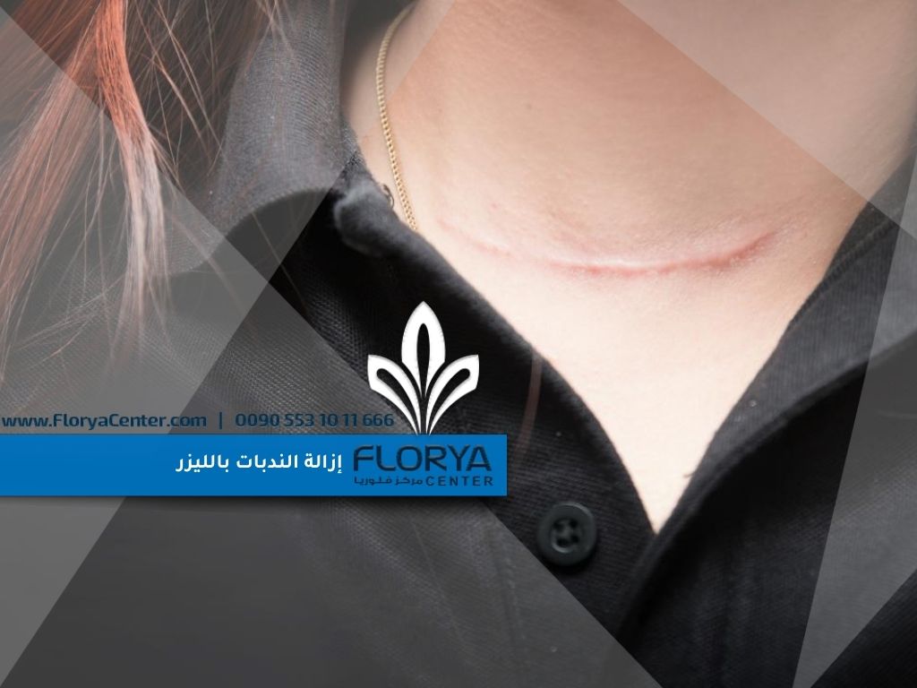 إزالة الندبات بالليزر