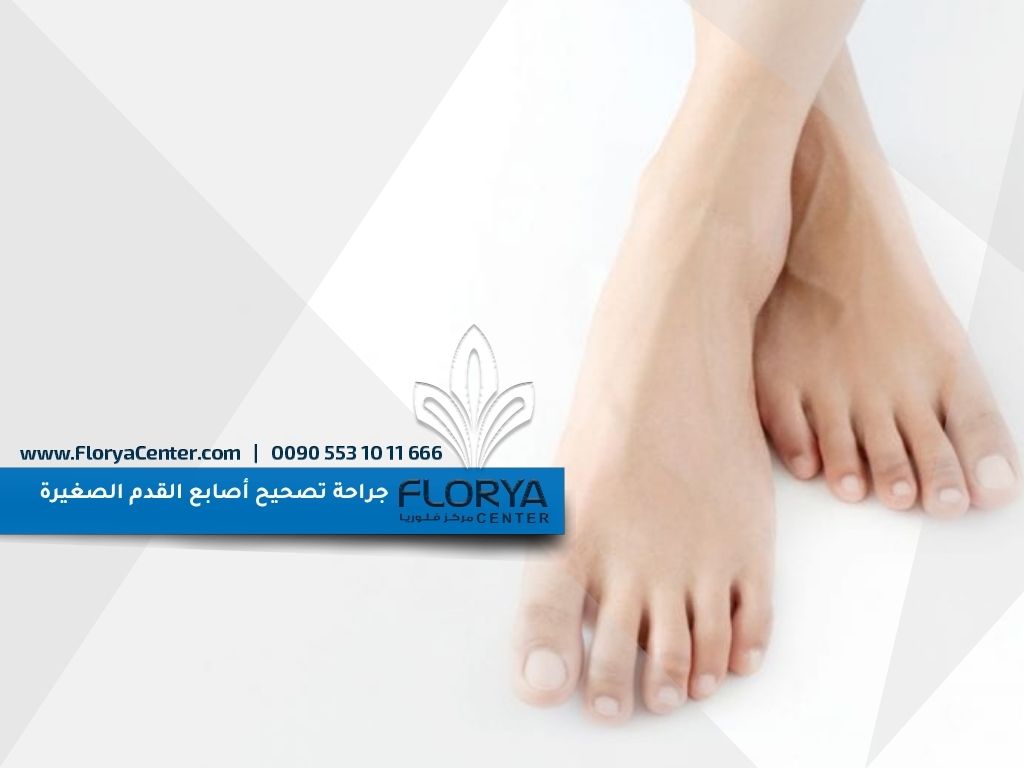 جراحة تصحيح أصابع القدم الصغيرة