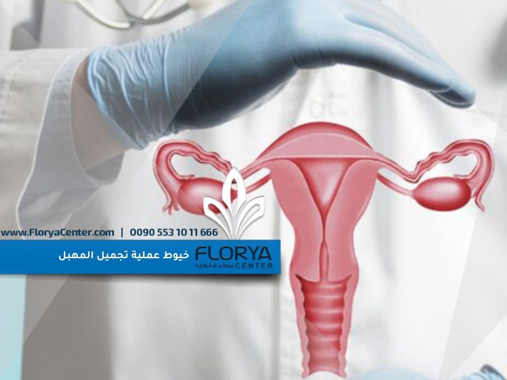 خيوط عملية تجميل المهبل