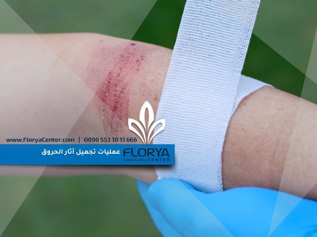 عمليات تجميل آثار الحروق