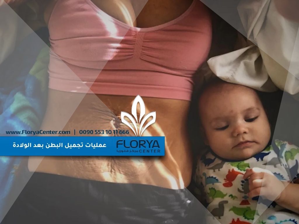 عمليات تجميل البطن بعد الولادة