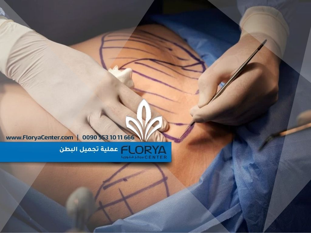عملية تجميل البطن