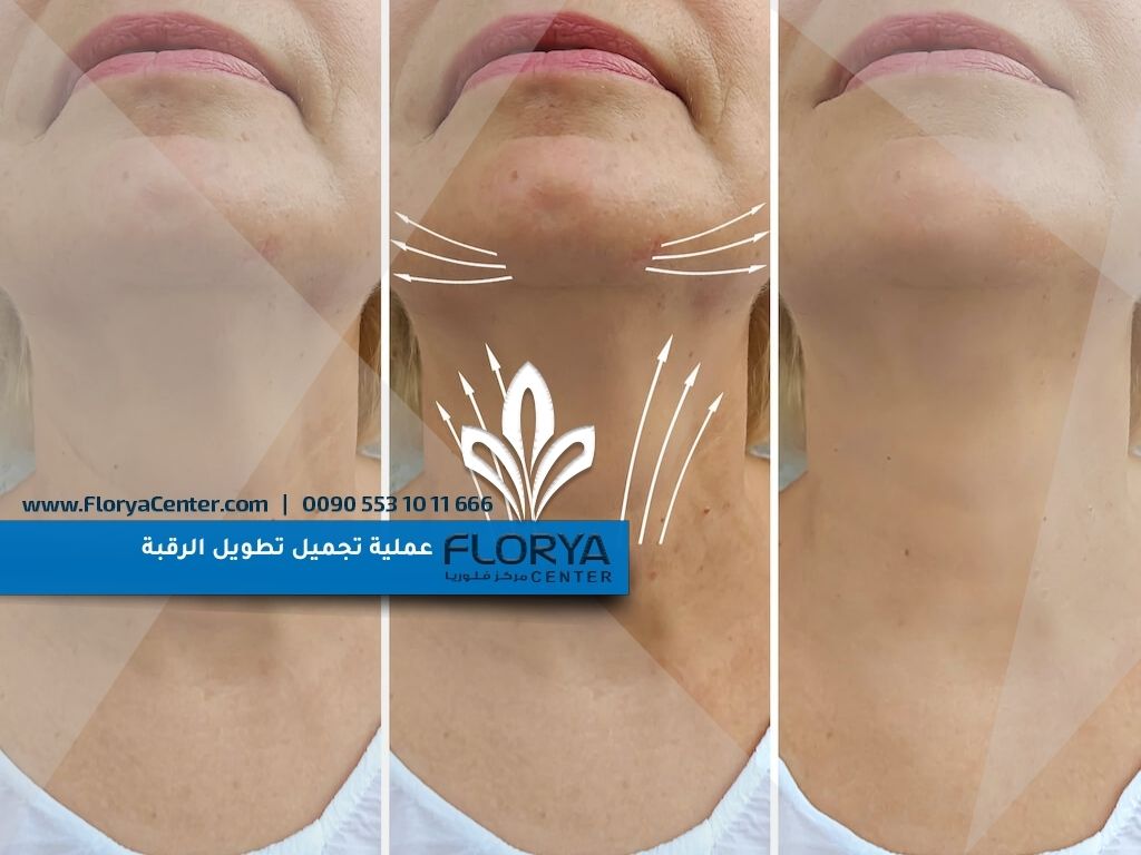 عملية تجميل تطويل الرقبة